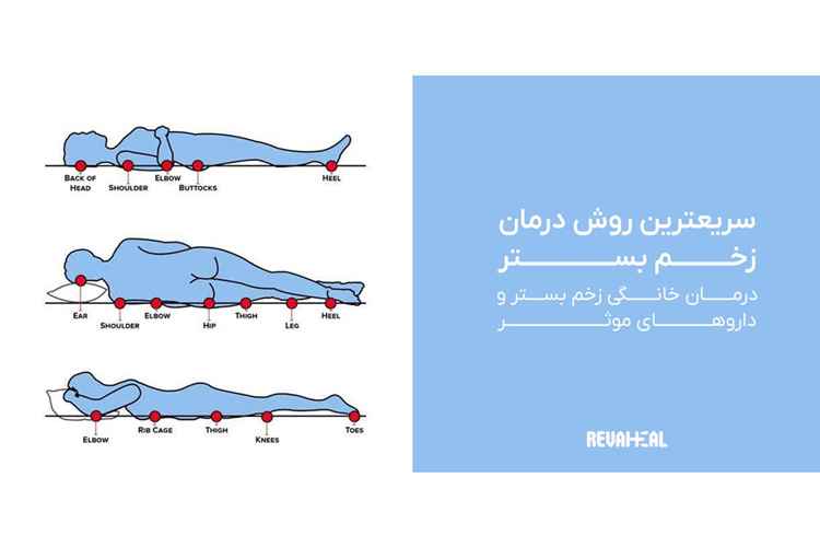 بهترین و سریعترین درمان زخم بستر