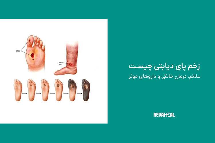 زخم پای دیابتی
